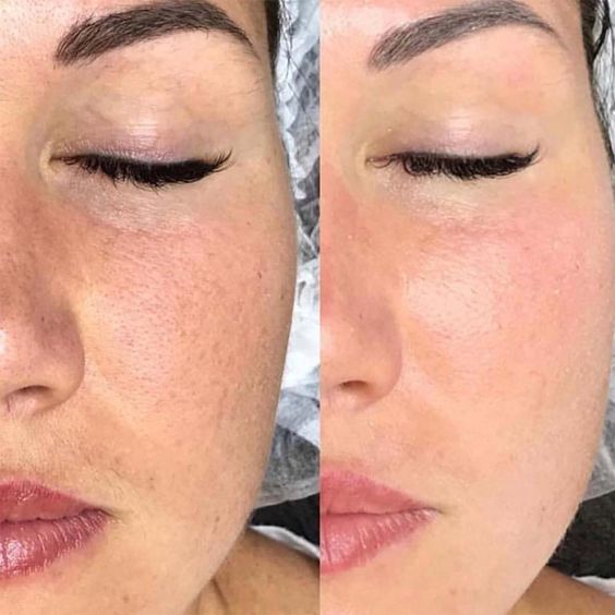 CREMA FACIAL CON ÁCIDO HIALURÓNIC